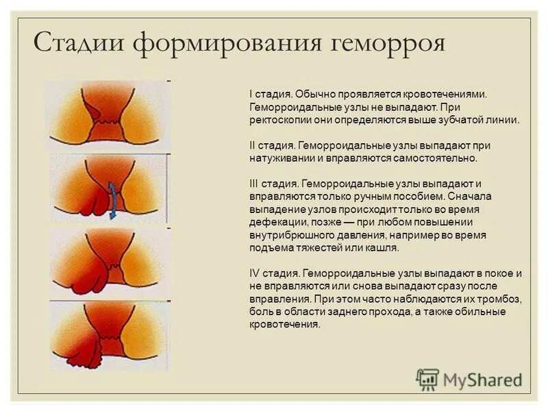 Последняя стадия геморроя фото Стадии наружного геморроя схема