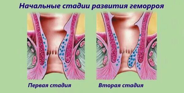 Последняя стадия геморроя фото Проктозан свечи: отзывы и инструкция при геморрое