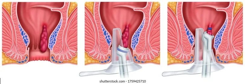 Последняя стадия геморроя фото 3 112 рез. по запросу "Open elastic" - изображения, стоковые фотографии, трехмер