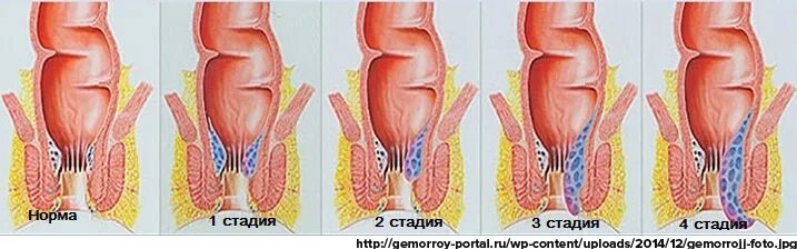 Последняя стадия геморроя фото Про геморрой мы не очень любим шутить. У нас его много" - новости Владимирской о