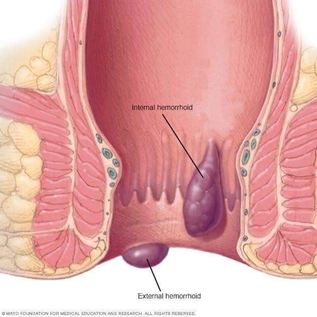 Последняя стадия геморроя фото Pin on Como saúde corpo