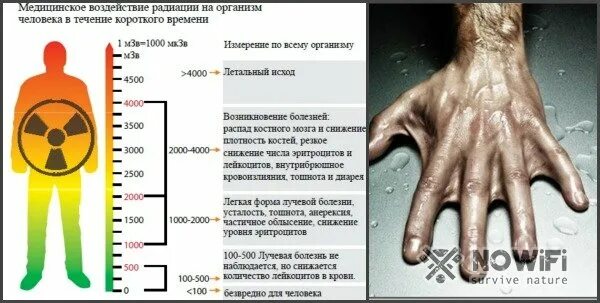 Последняя стадия лучевой болезни фото В чем измеряется радиация: единицы измерения, дозиметром