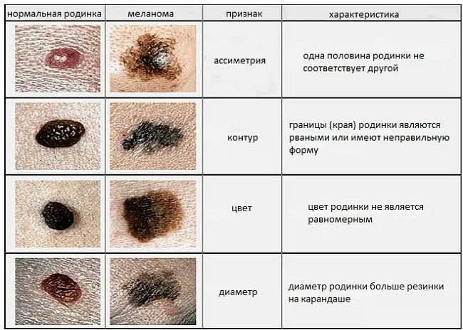 Последняя стадия меланомы фото Как вовремя распознать меланому?