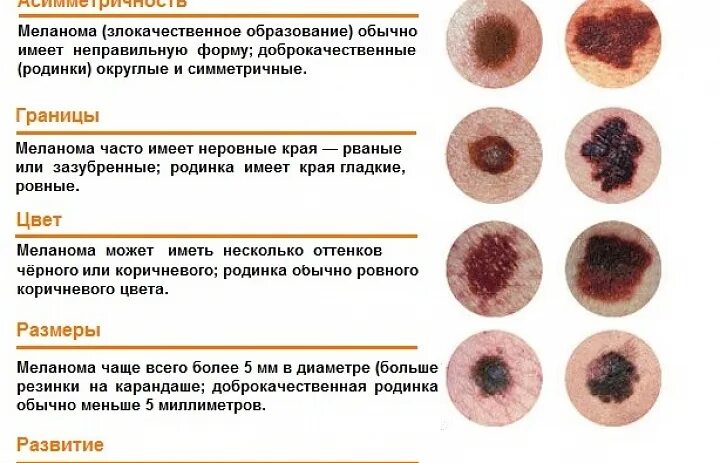 Последняя стадия меланомы фото Новости