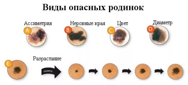 Последняя стадия меланомы фото Удаление родинок по доступной цене в Подольске