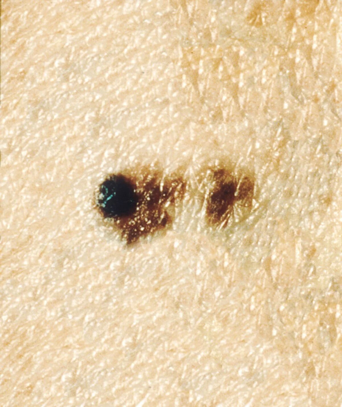 Последняя стадия меланомы фото Súbor:Melanoma (3).jpg - Wikipédia