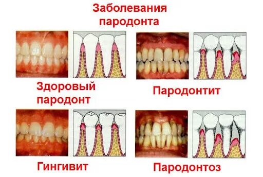 Последняя стадия пародонтоза фото Имплантация зубов при пародонтозе и пародонтите в Москве под ключ