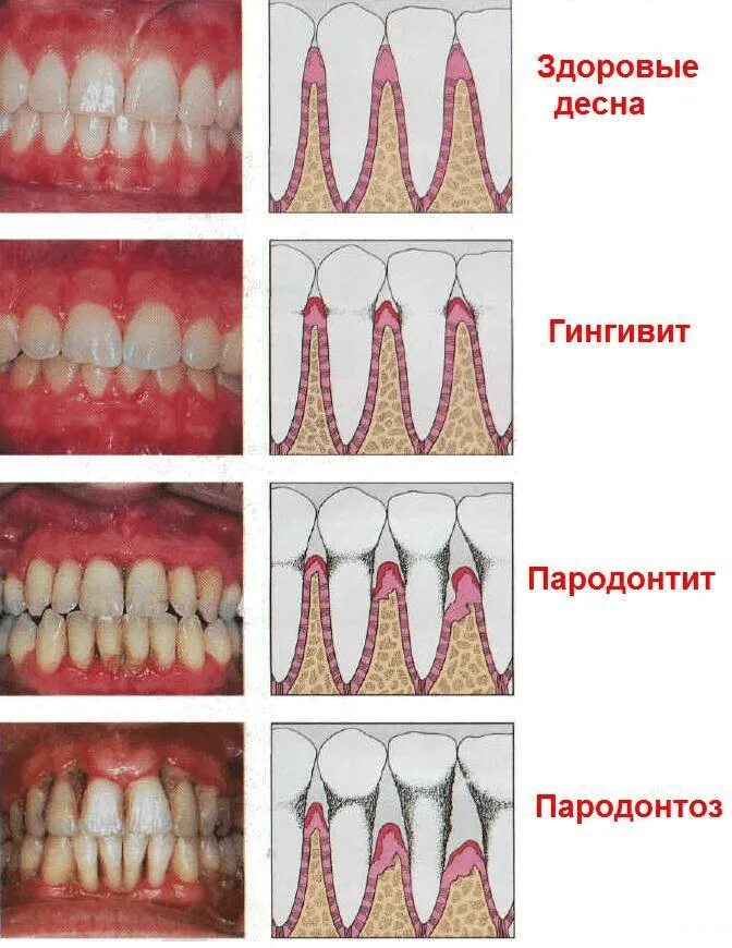 Последняя стадия пародонтоза фото Диагностика и эффективное лечение десен зубов в Новосибирске