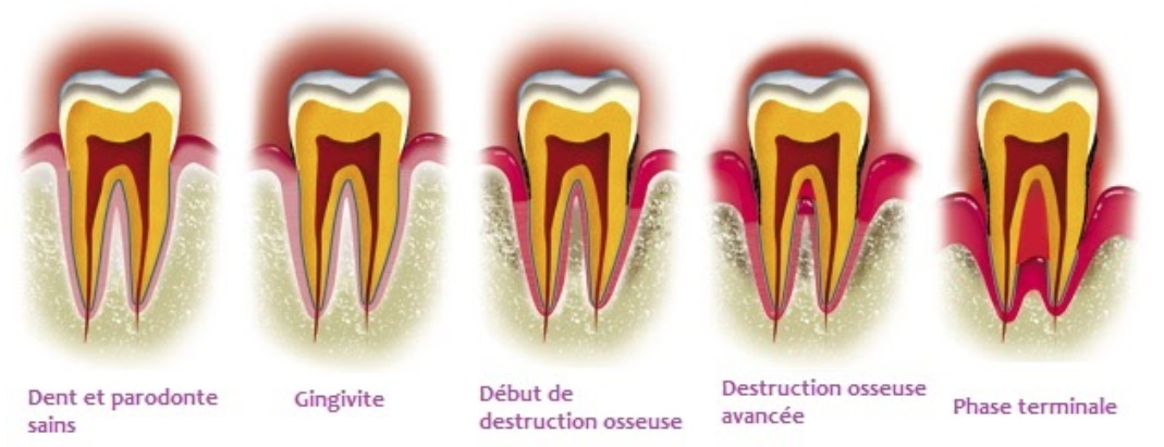 Последняя стадия пародонтоза фото paradontologi Centre Oro Facial - Cabinet Dentaire