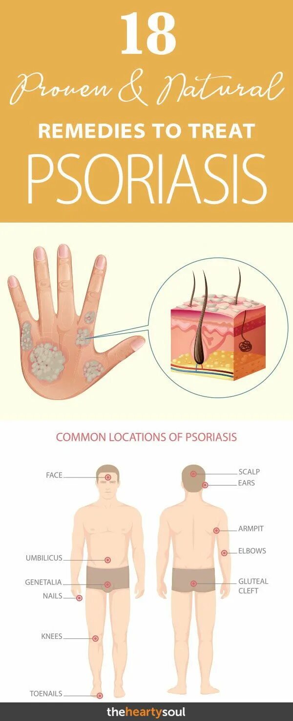 Последняя стадия псориаза фото Psoriasis can be incredibly irritating as it can cause a number of unpleasant sk