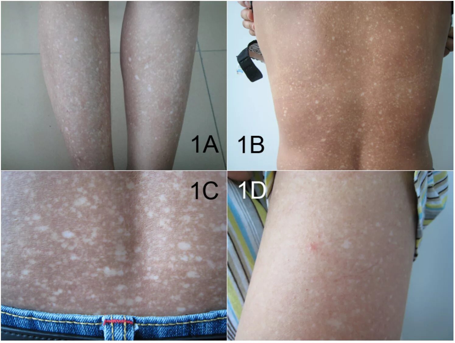 JLE - European Journal of Dermatology - Childhood psoriasis