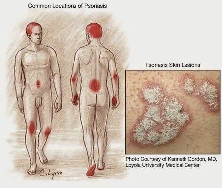 Последняя стадия псориаза фото Health Center: PsoriasisPsoriasis is one of the most stubborn skin diseases. It 