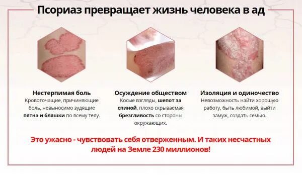 Последняя стадия псориаза фото Красота кожного покрова с psorix купить по цене 1149 ₽ в Москве на PromPortal.Su