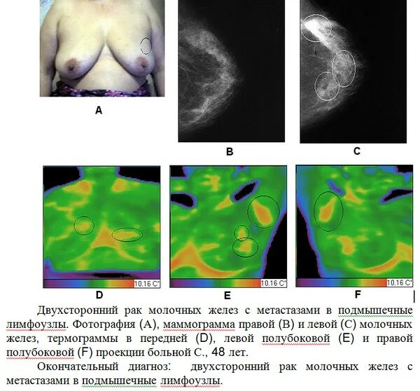 Последняя стадия рака груди фото Термографическая диагностика заболеваний молочных желез.Продолжение. Здравия жел