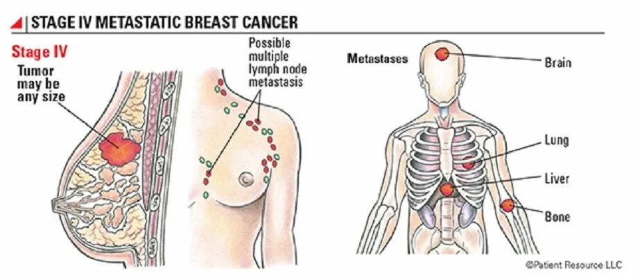 Последняя стадия рака груди фото 12 Essential Facts About Breast Cancer Every Woman Should Know Elite Readers