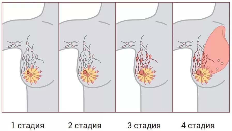 Последняя стадия рака груди фото Стадии РМЖ