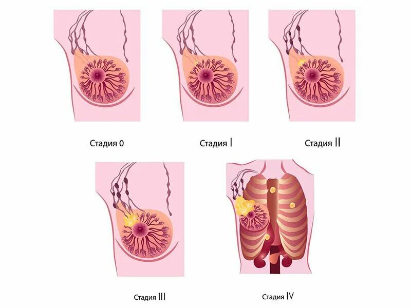 Последняя стадия рака груди фото Рак молочной железы - диагностика, симптомы, стадии, первые признаки и лечение в