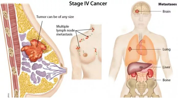 Последняя стадия рака груди фото Стадии рака молочной железы: прогноз, лечение, симптомы в международной клинике 