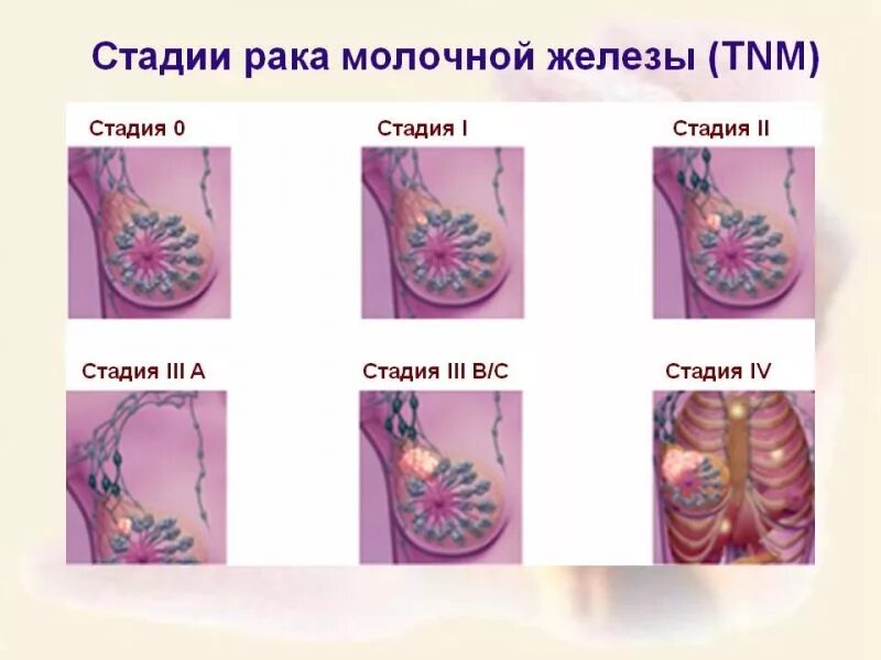 Последняя стадия рака груди фото Симптомы заболеваний, диагностика, коррекция и лечение молочных желез kvd9spb.ru