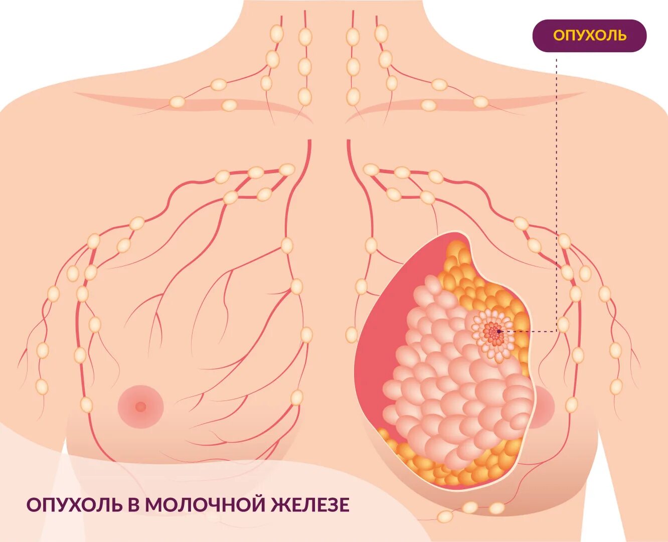 Последняя стадия рака груди фото Доброкачественные опухоли молочных желез - ГБУЗ "Республиканский онкологический 