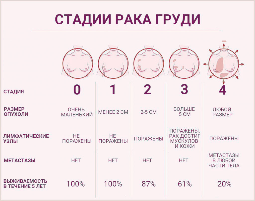 Последняя стадия рака груди фото Лечение рака молочной железы - Бушуев Семен Дмитриевич