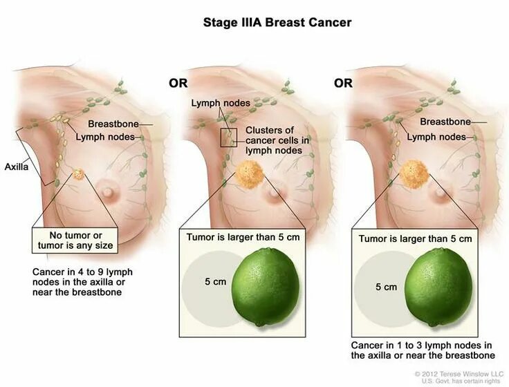 Последняя стадия рака груди фото Pin on Breast cancer