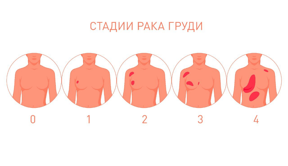 Последняя стадия рака груди фото Как диагностировать рак груди? - Klinik.by