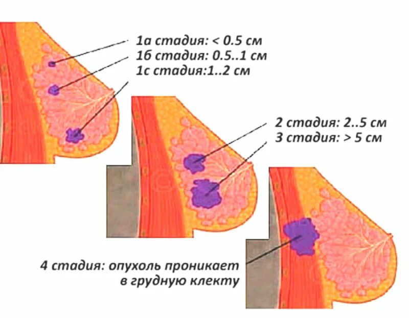 Последняя стадия рака груди фото Расшифровка отчета о патологии опухолей молочных желез. Диагноз, степень злокаче