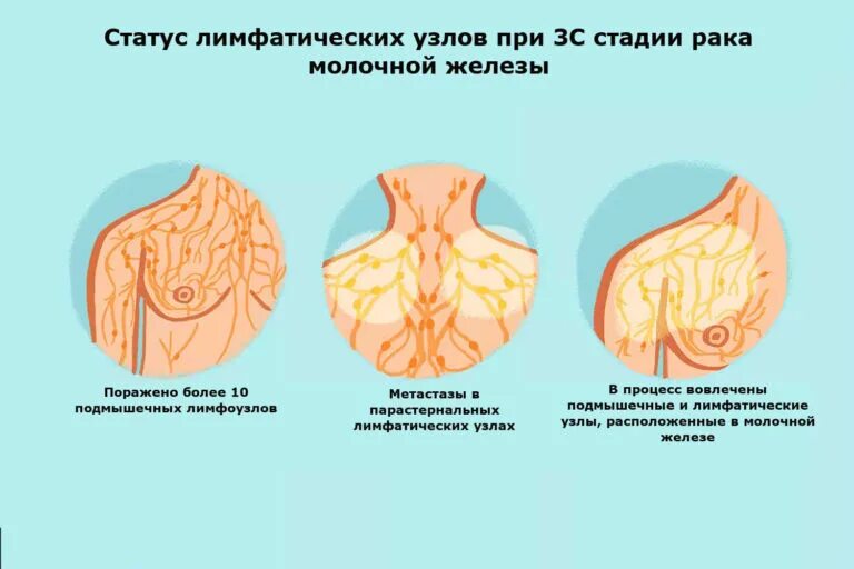 Последняя стадия рака груди фото Рак груди 3 стадия, прогноз рака молочной железы 3 степени Patient-mt.ru