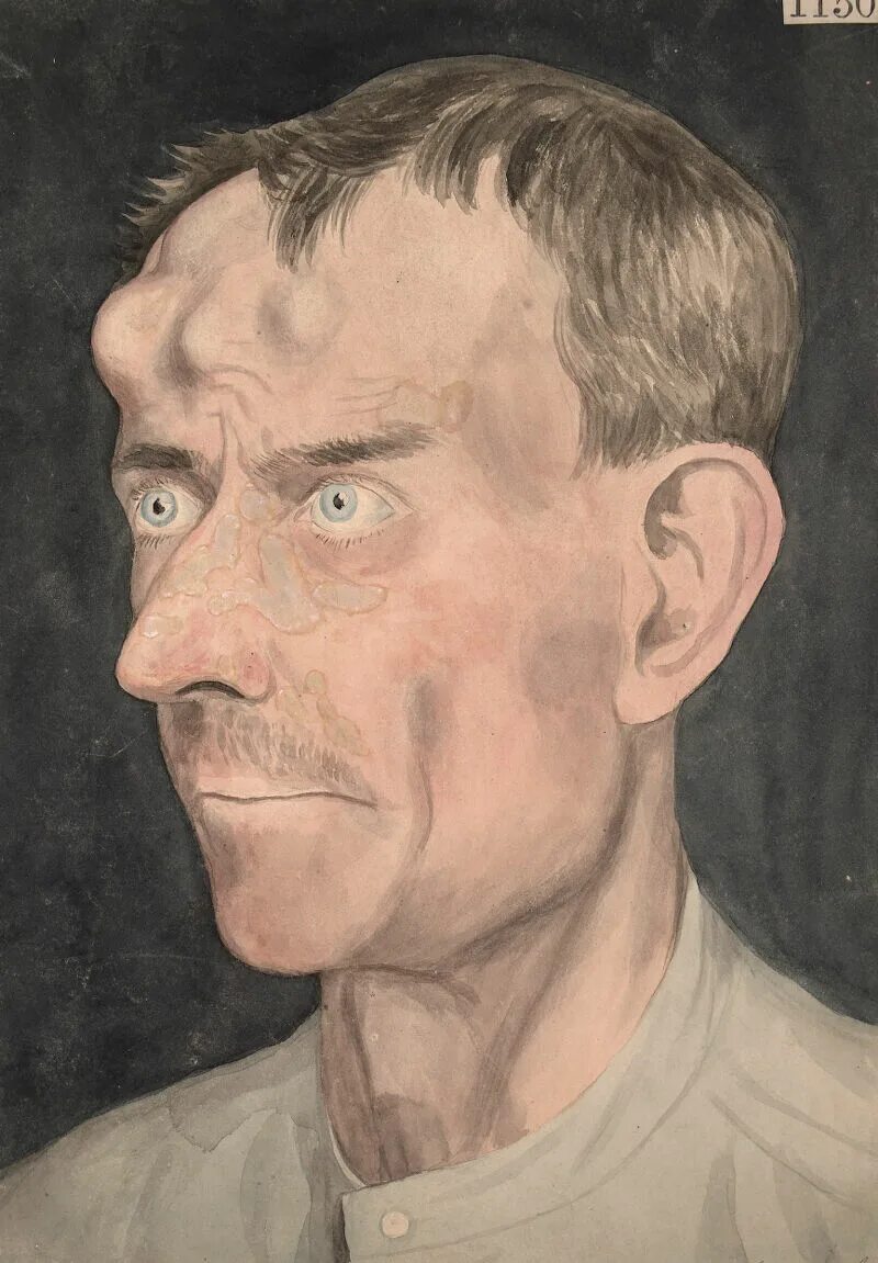 Последняя стадия сифилиса фото Face of a man affected with tertiary syphilis Wellcome Collection