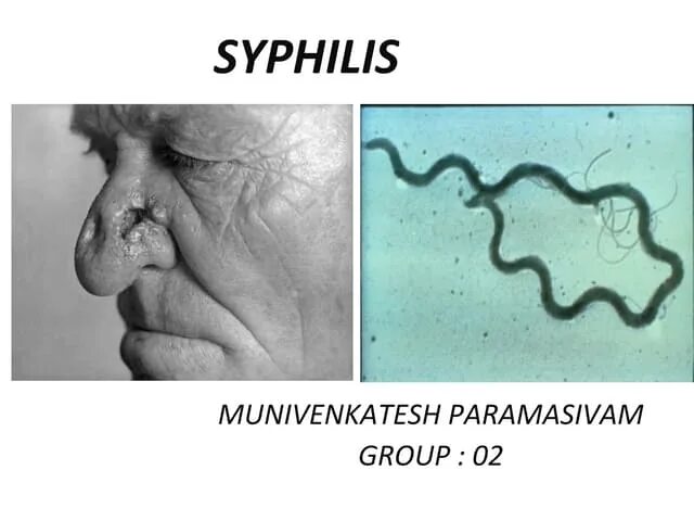 Последняя стадия сифилиса фото Syphilis