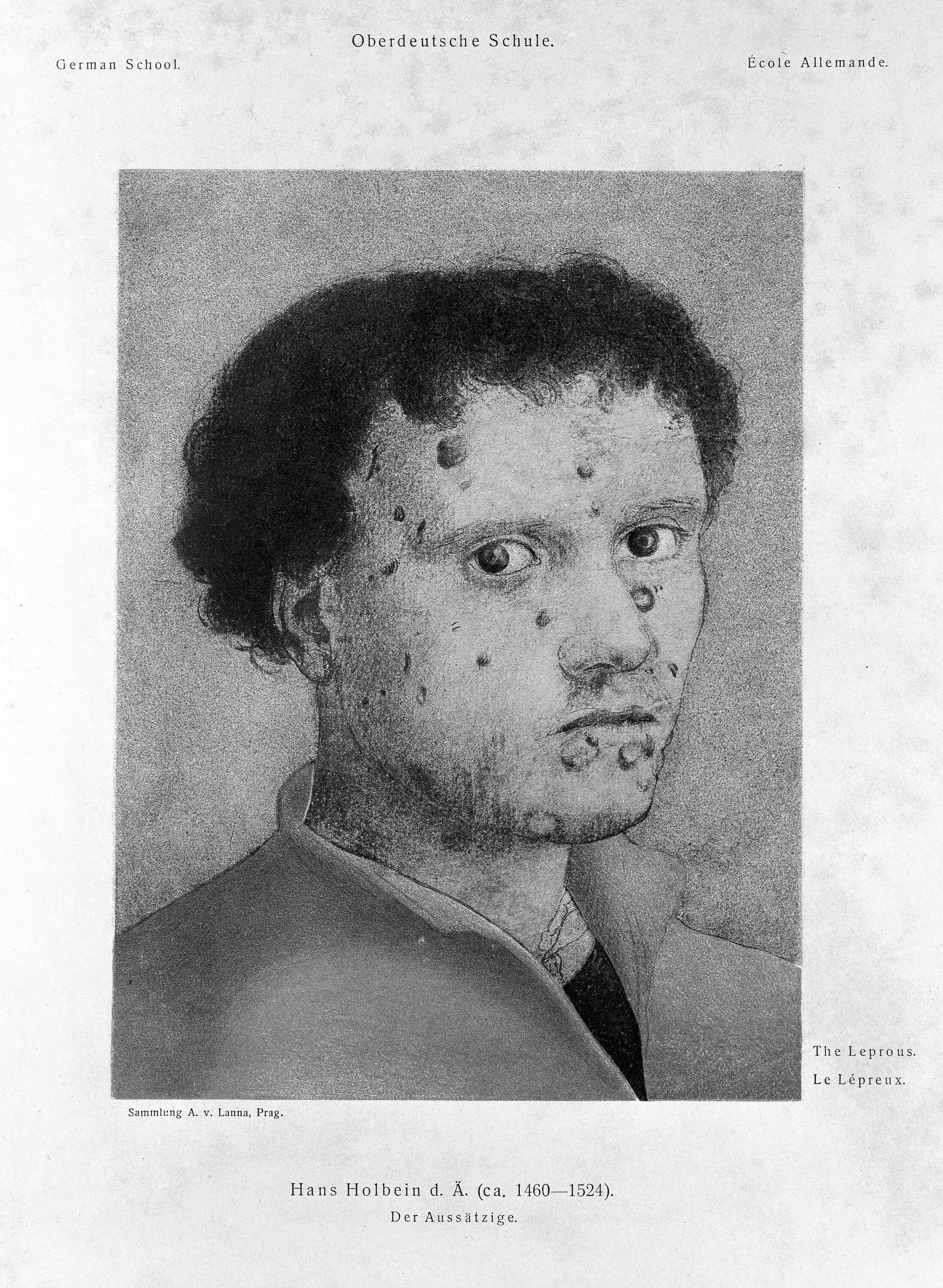 Последняя стадия сифилиса фото File:A young man with an ulcerated face. Lithograph after H. Holb Wellcome L0007