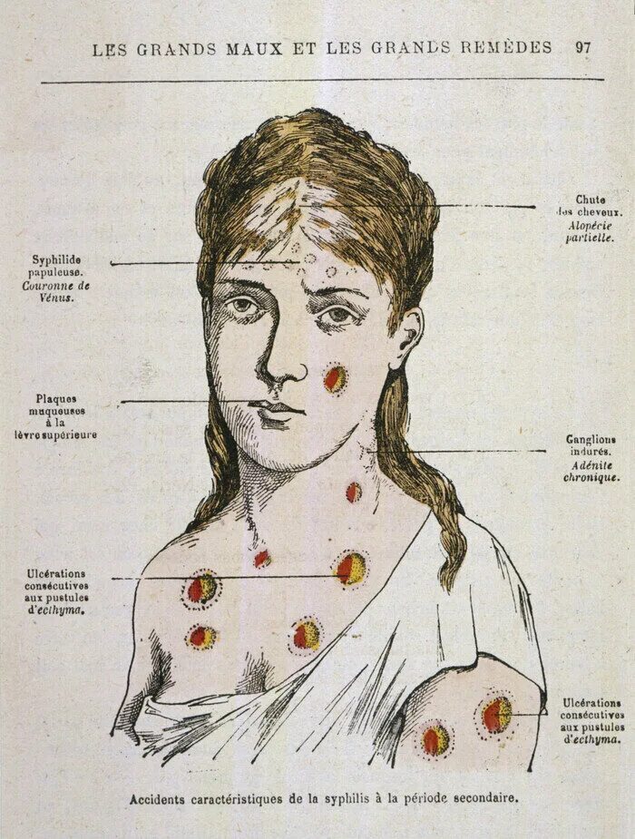 Последняя стадия сифилиса фото Похождения сифилиса в Российской империи Пикабу Дзен