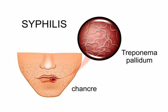 Последняя стадия сифилиса фото Syphilis Изображения: просматривайте стоковые фотографии, векторные изображения 