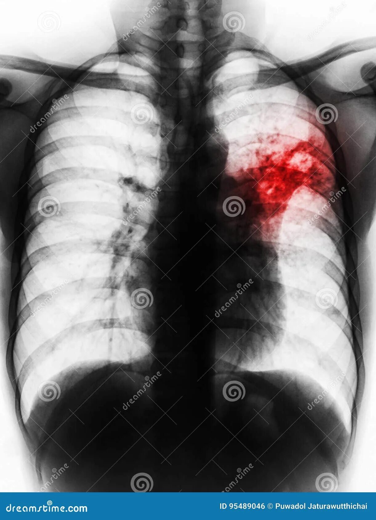 Последняя стадия туберкулеза фото Pulmonary Tuberculosis . Film Chest X-ray Show Alveolar Infiltrate at Left Middl