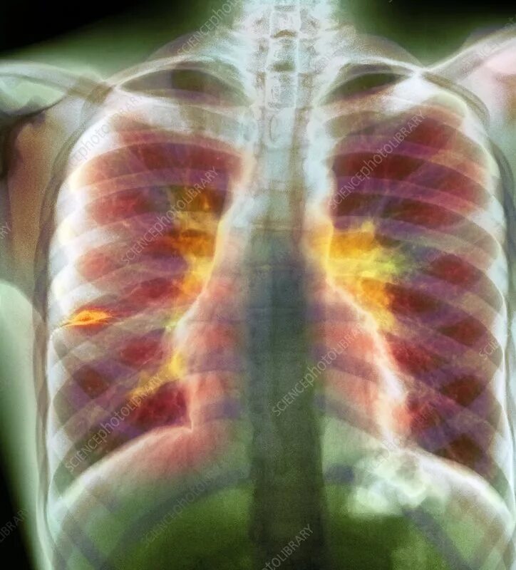 Последняя стадия туберкулеза фото Tuberculosis lymphadenopathy, X-ray - Stock Image - C007/2678 - Science Photo Li