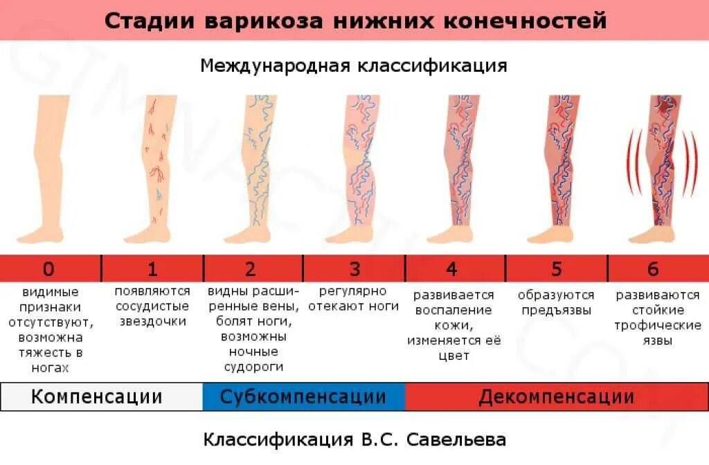 Последняя стадия варикоза фото Диагноз варикоза