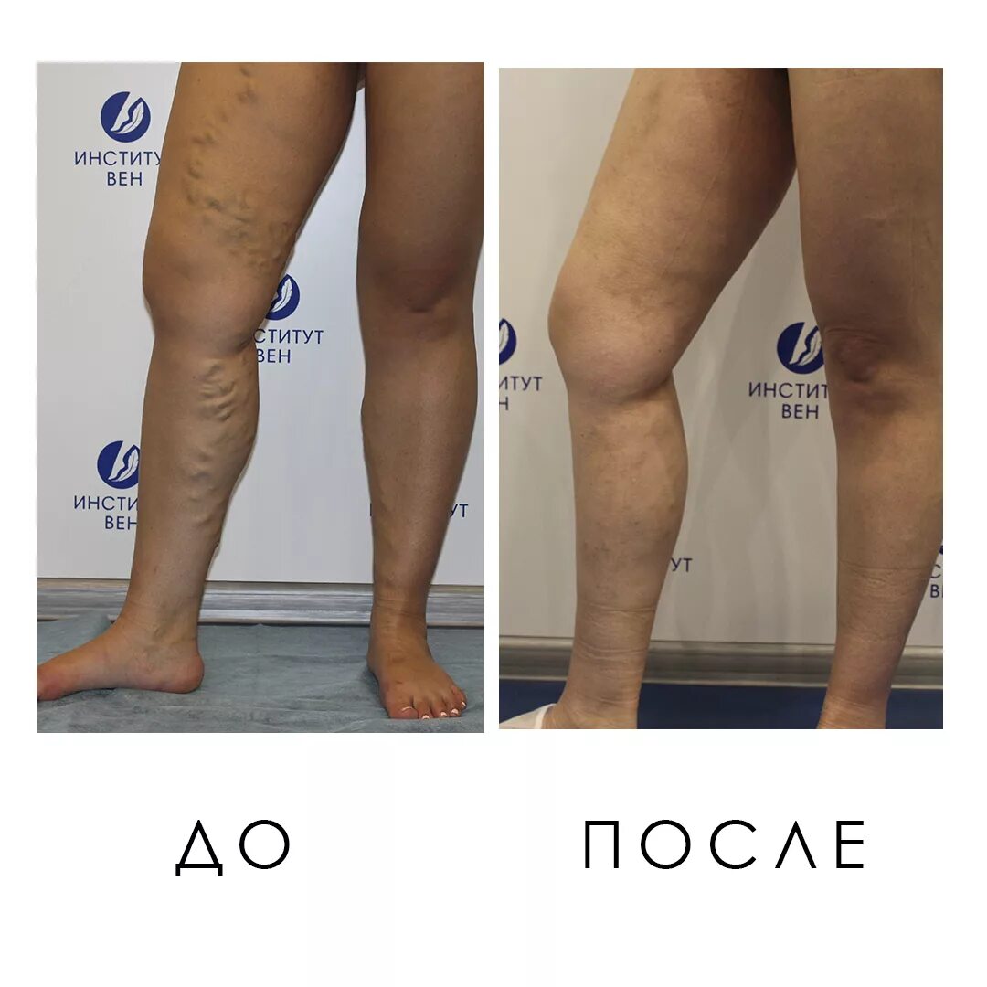 Последняя стадия варикоза фото Минифлебэктомия - лечение варикоза ног лазером в Киеве и Харькове - клиника флеб