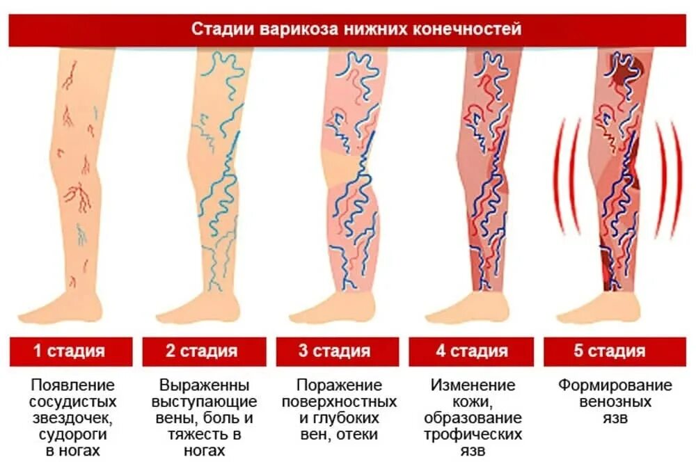 Последняя стадия варикоза фото Профилактика варикозного расширения вен нижних конечностей - Медицинский портал 