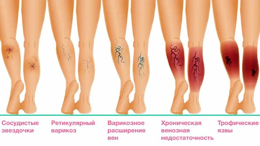 Последняя стадия варикоза фото Как лечить трофическую язву - Симптомы трофической язвы