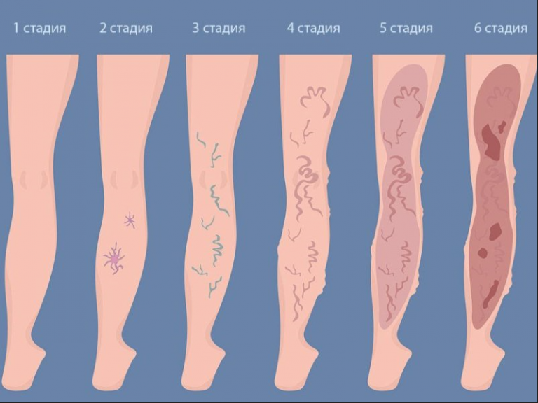 Последняя стадия варикоза фото Лечение трофических язв в Морозовске, запись, цены ООО Здоровье