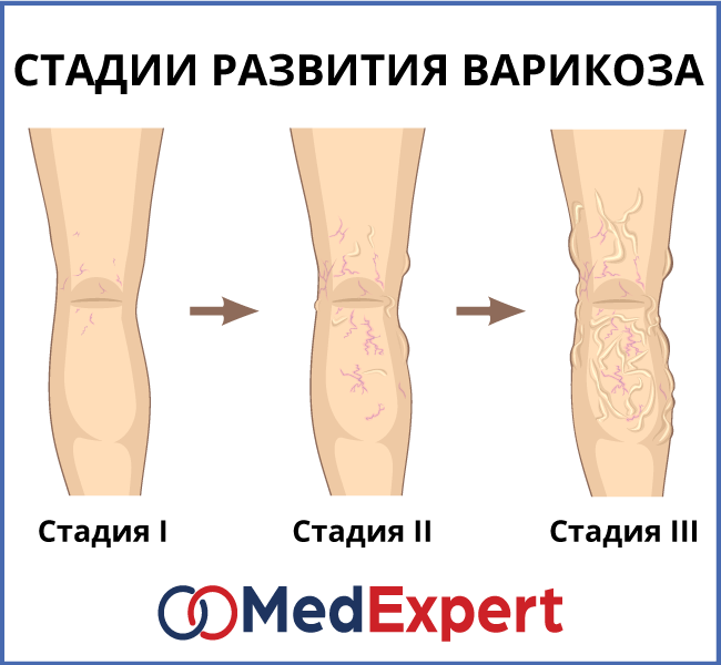 Последняя стадия варикоза фото ВАРИКОЗНОЕ РАСШИРЕНИЕ ВЕН MED Expert