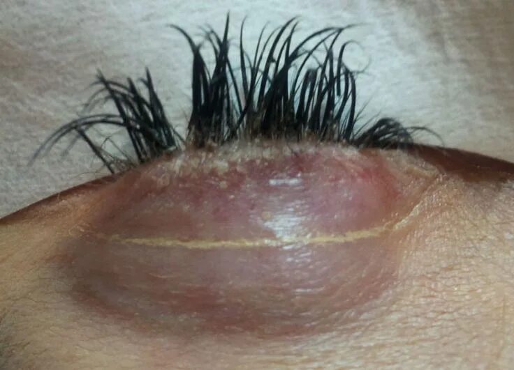 Последствия наращивания фото Health Dangers of Using Eyelash Extensions Eyelash extensions care, Eyelash exte