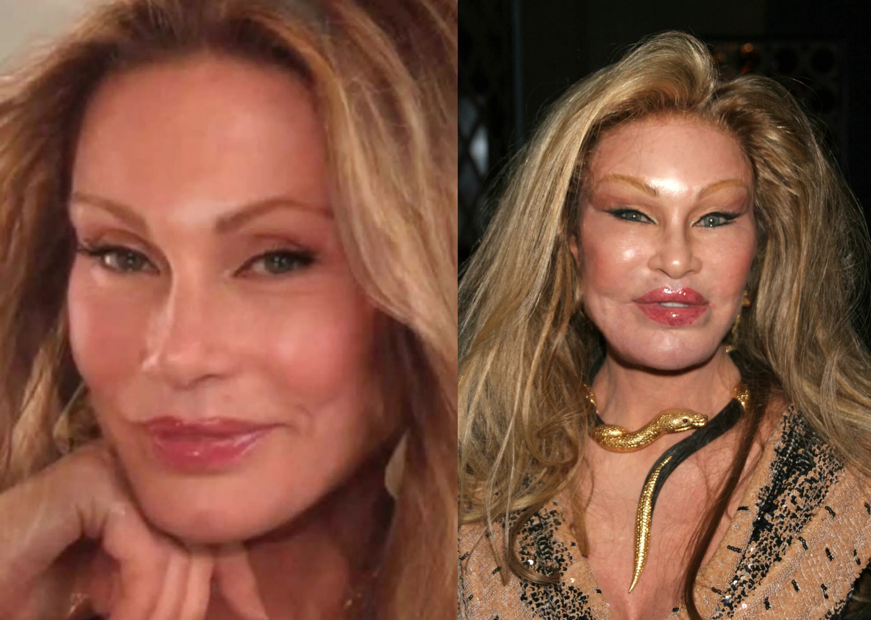 Последствия пластики фото 26 Most Expensive Celebrity Plastic Surgeries Ever and How Much They Cost