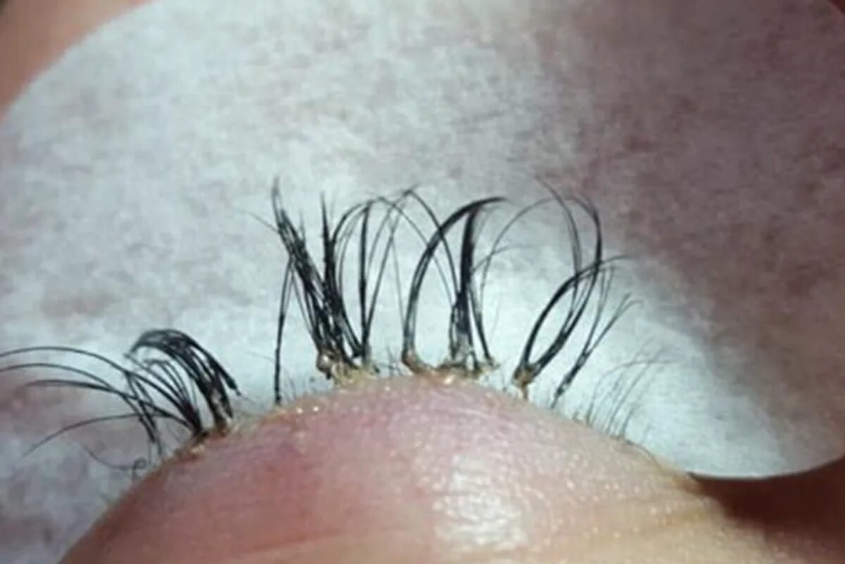 Последствия после наращивание ресниц фото Beauty expert issues warning after woman’s eyelash extensions cause her real one