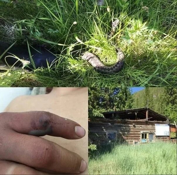 Последствия укуса гадюки фото A woman who has been poisoned by a venomous snake Everything happened on the lak