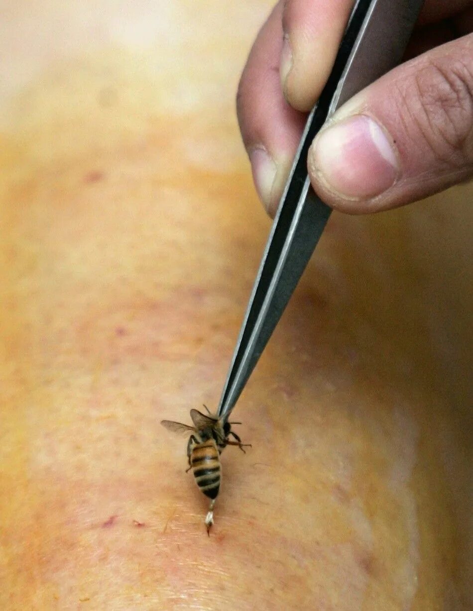 Последствия укуса осы фото World's Most Bizarre and Weirdest Medical Cures: Do They Work? PHOTOS IBTimes