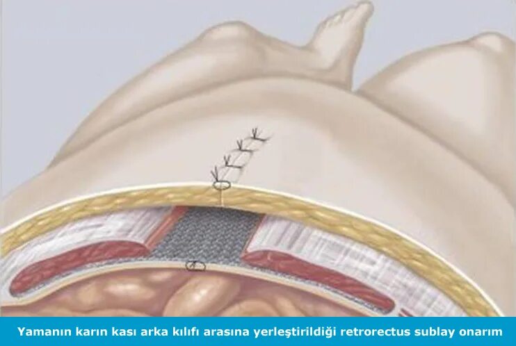 Послеоперационные фото грыжи белой линии живота Сетка после грыжи пупочной