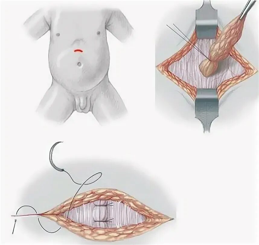 Послеоперационные фото грыжи белой линии живота Грыжа живота: лечение, виды, симптомы грыж передней брюшной стенки