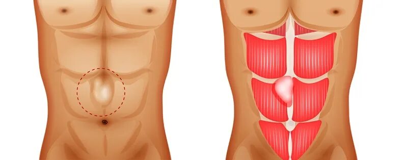 Послеоперационные фото грыжи белой линии живота Грыжа белой линии живота: симптомы, диагностика, лечение грыжи белой линии живот